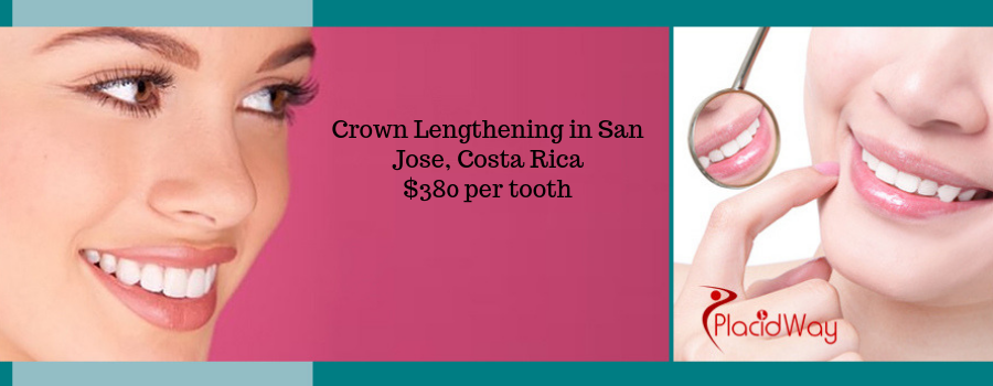 Crown Lengthening in San Jose, Costa Rica Cost